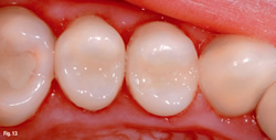 Penrith Dental Clinic | Composite White Fillings - Dentist Sydney