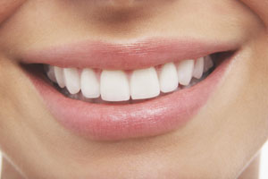 Dental Bonding Penrith