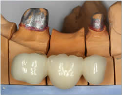 Penrith Dental Clinic | Dental Bridges - Dentist Sydney
