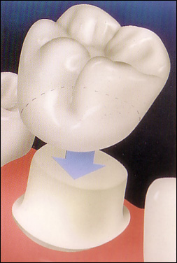 Penrith Dental Clinic | Dental Crowns - Dentist Sydney