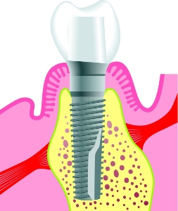 Dental Implants Penrith