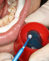Penrith Dental Clinic | Fluoride Treatment - Dentist Sydney