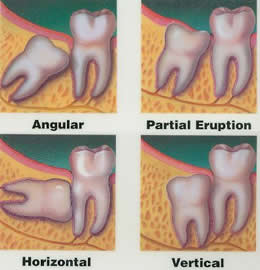Impacted Wisdom Teeth
