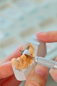 Penrith Dental Clinic | Inlays / Onlays - Dentist Sydney