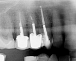 Penrith Dental Clinic | Root Canal Therapy - Dentist Sydney