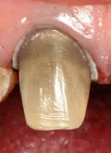 Penrith Dental Clinic | Root Canal Treatment - Dentist Sydney