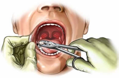 Tooth Extraction Penrith