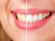 Must-have Teeth Whitening Home Remedies